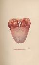  NORTON, ARTHUR TREHERN, Affections of the Throat and Larynx. Their Classification, Pathology, Diagnosis, and Treatment